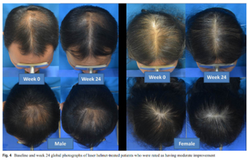 before and 24 weeks after red light therapy in male androgenetic alopecia and female patterned hair loss patients