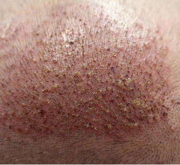 scalp folliculitis after hair transplant