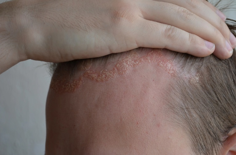 scalp psoriasis