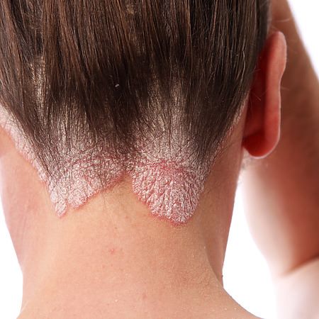 scalp psoriasis