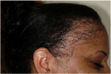 traction alopecia