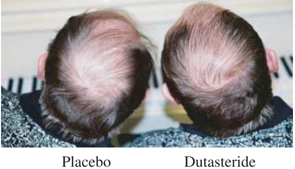 Dutasteride medication vs Placebo on the crown