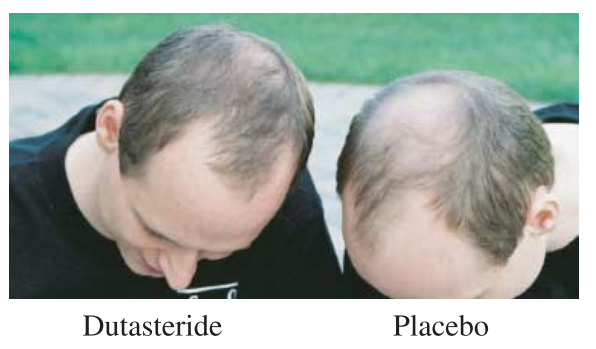 Dutasteride medication vs Placebo