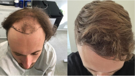 Hair transplant before and after