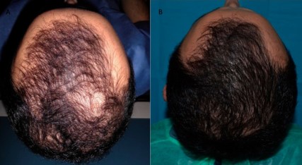 PRP hair regrowth