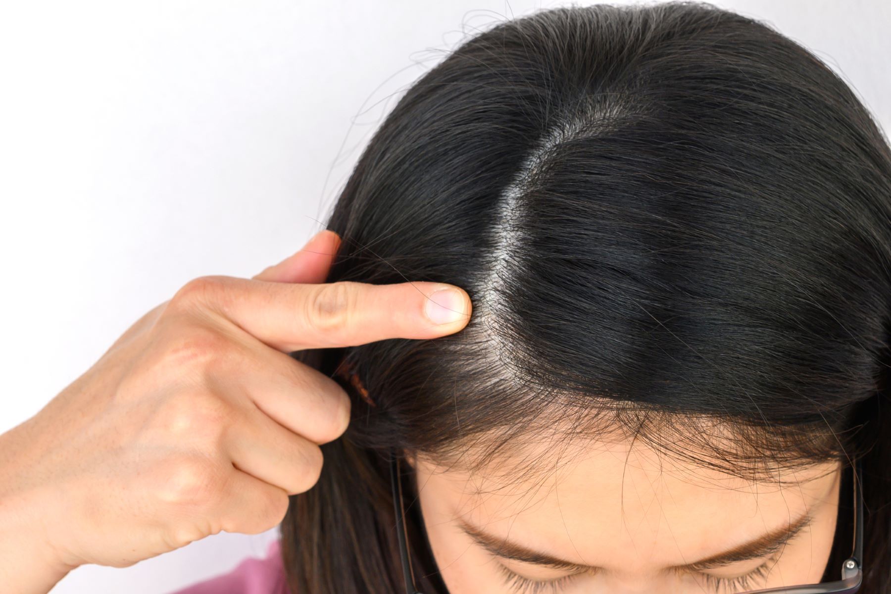 Woman with female pattern baldness