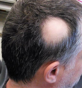 alopecia areata