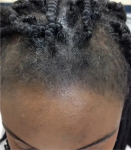 traction alopecia