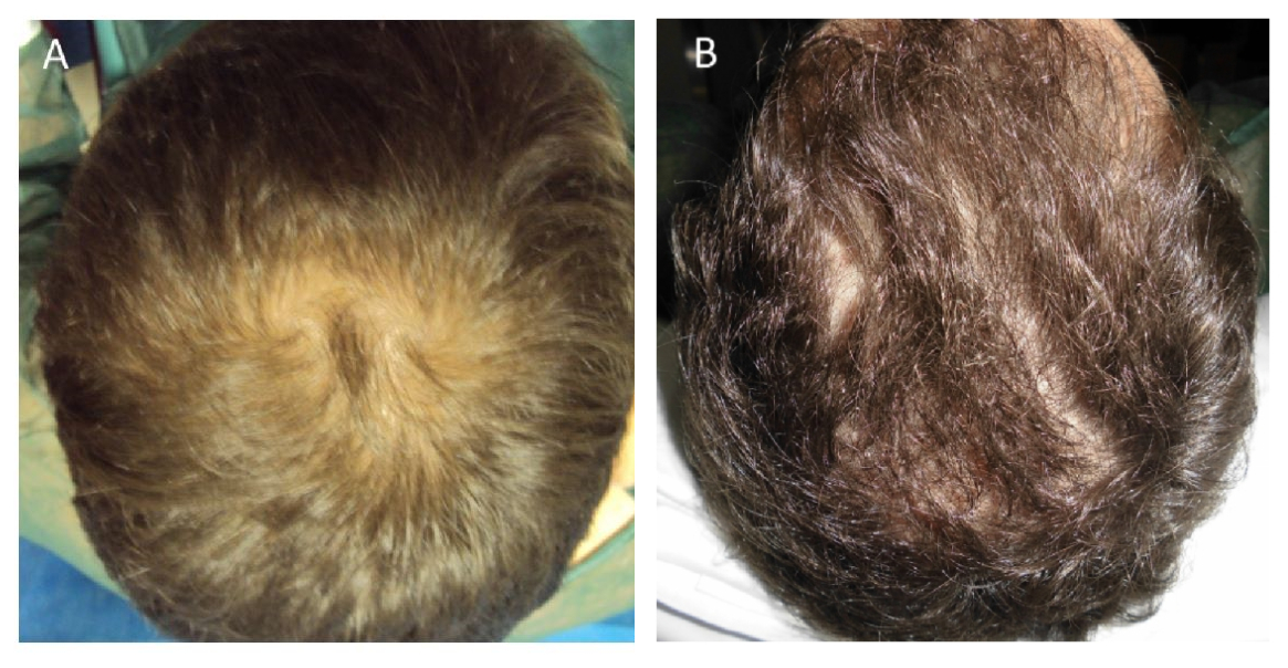 Effect of autologous activated Platelet Rich Plasma