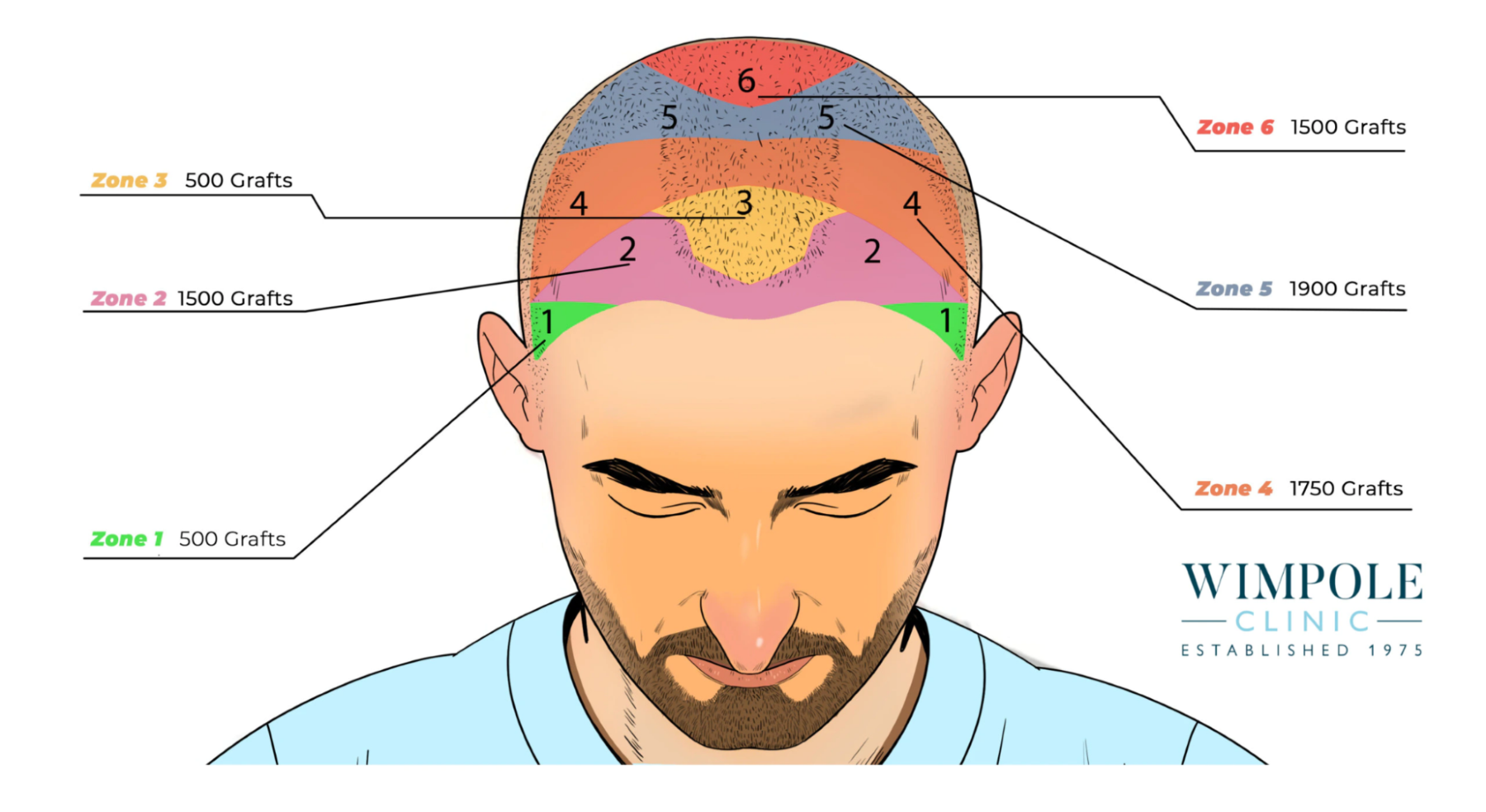 Hair graft calculator