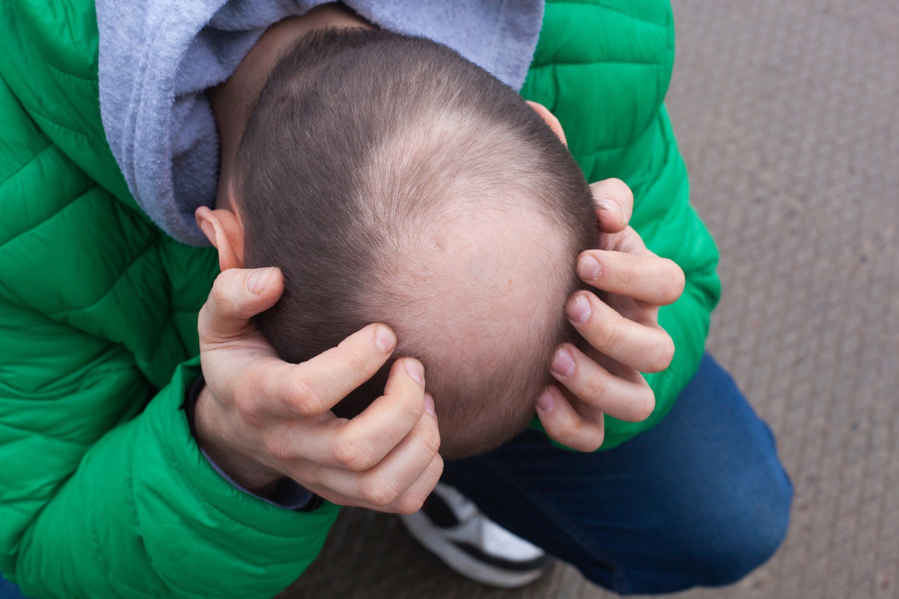 Hair loss in male pattern baldness