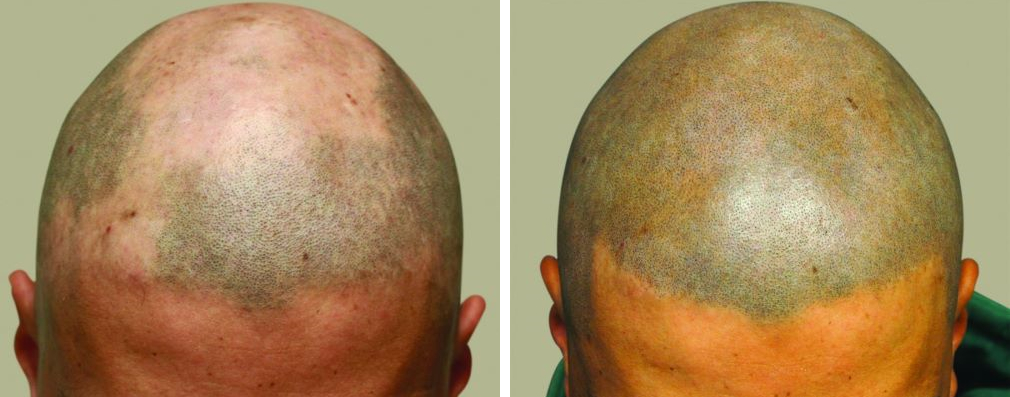 Before and after SMP for alopecia areata