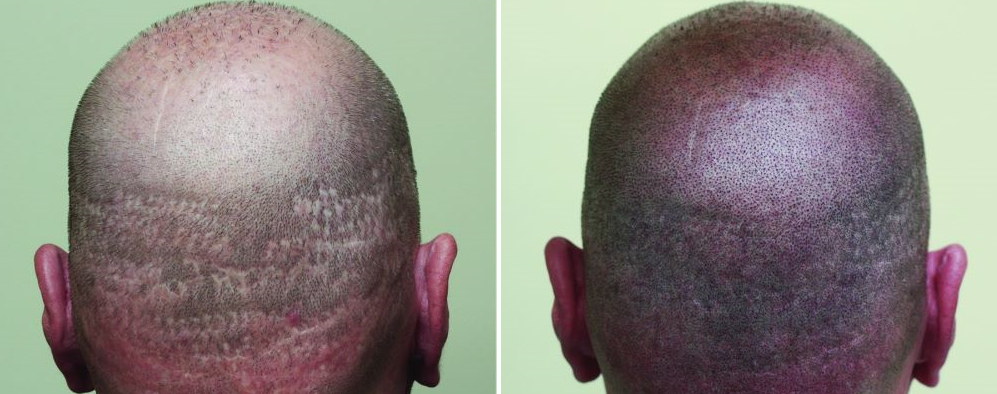 Before and after SMP for hair transplant scars