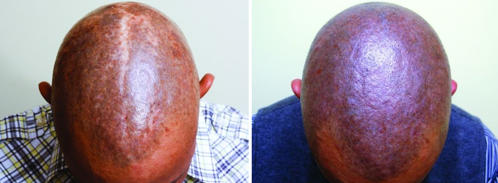 Before and after SMP for scarring alopecia