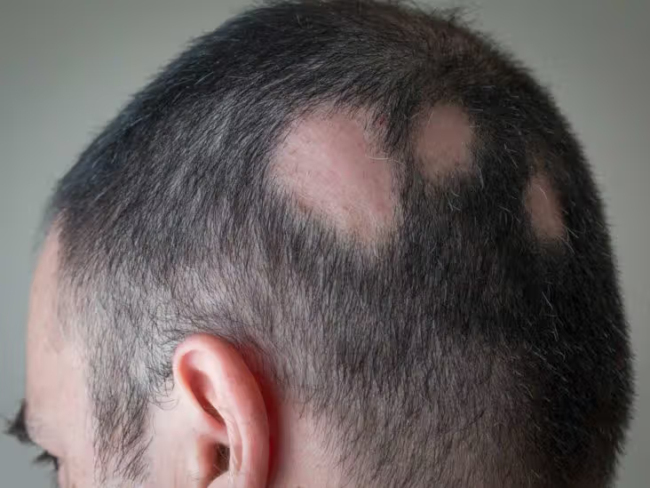 Man with alopecia areata