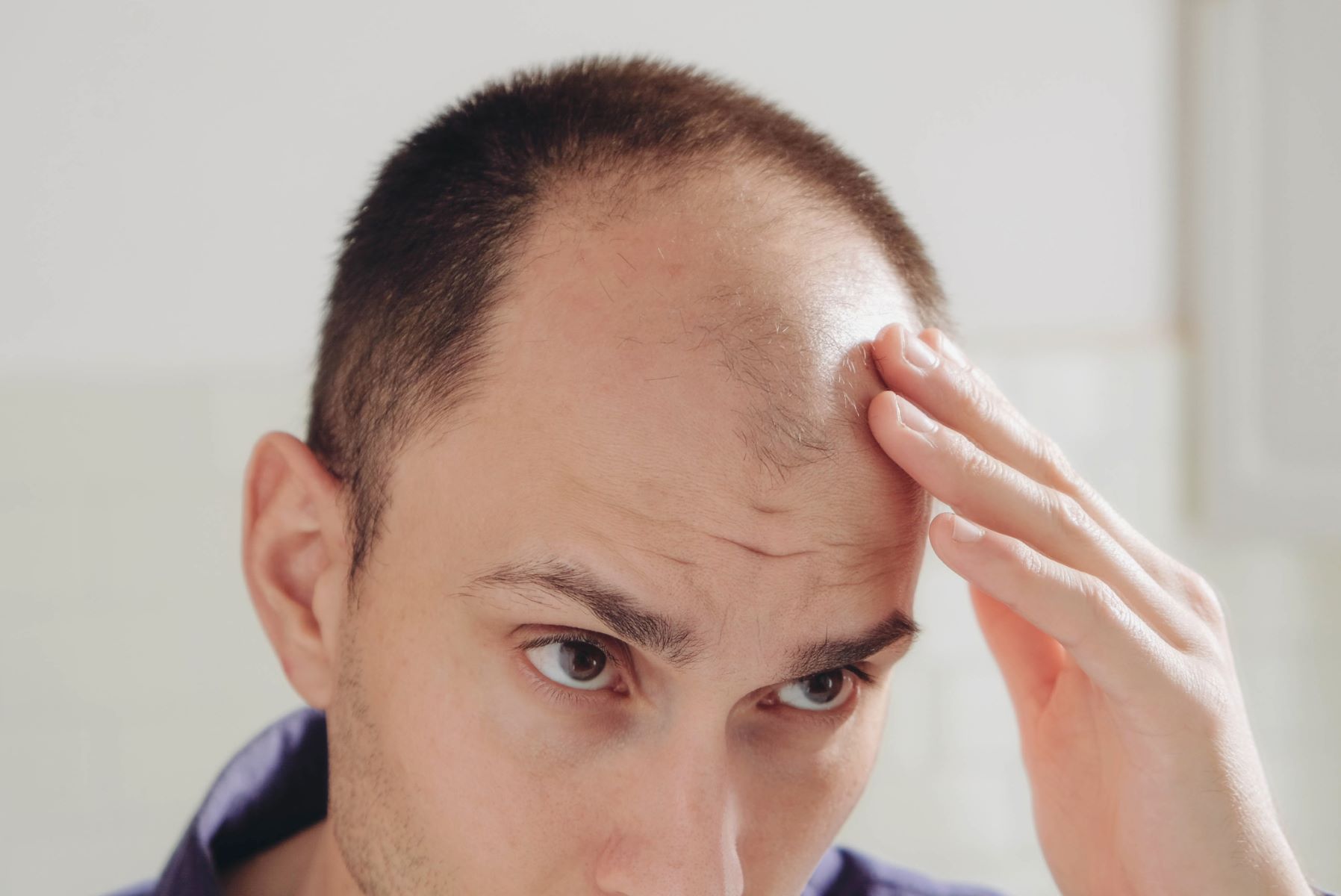 Man with male pattern baldness