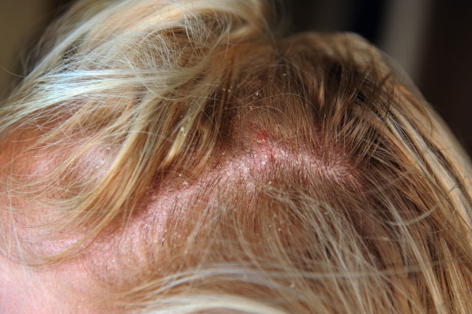 Patient with seborrheic dermatitis