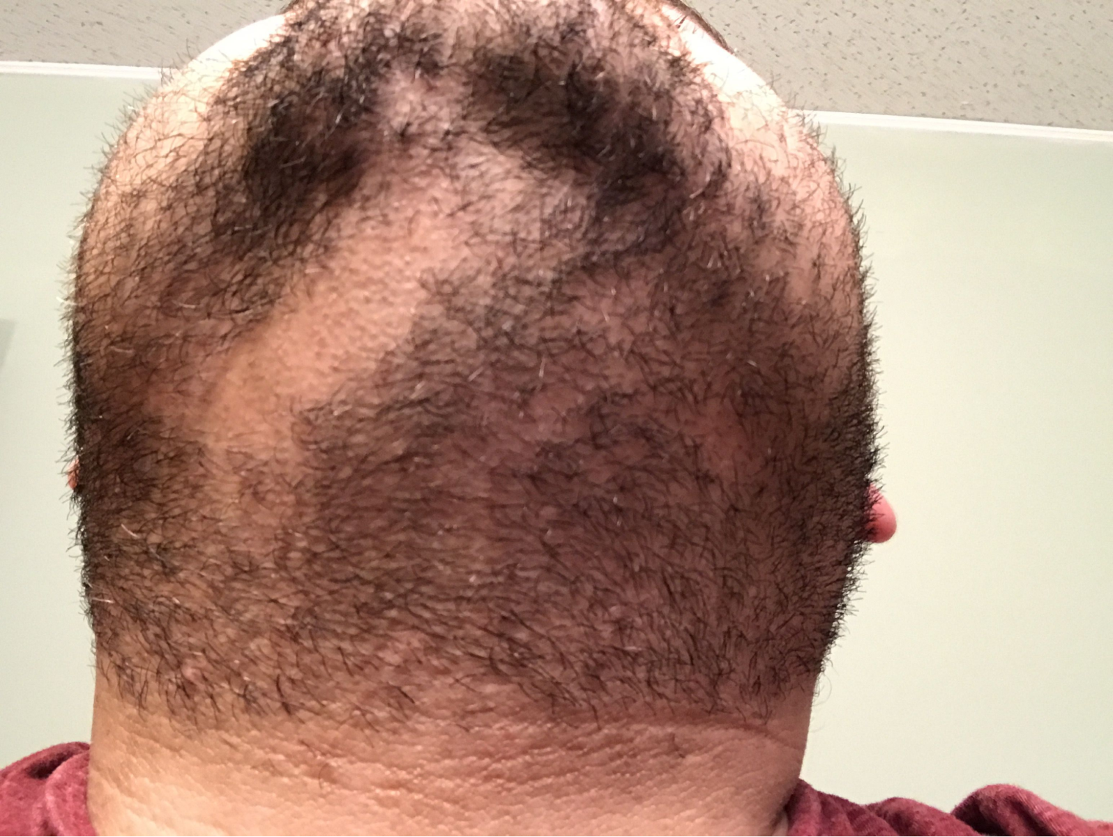 Trichotillomania of the beard under a man’s chin