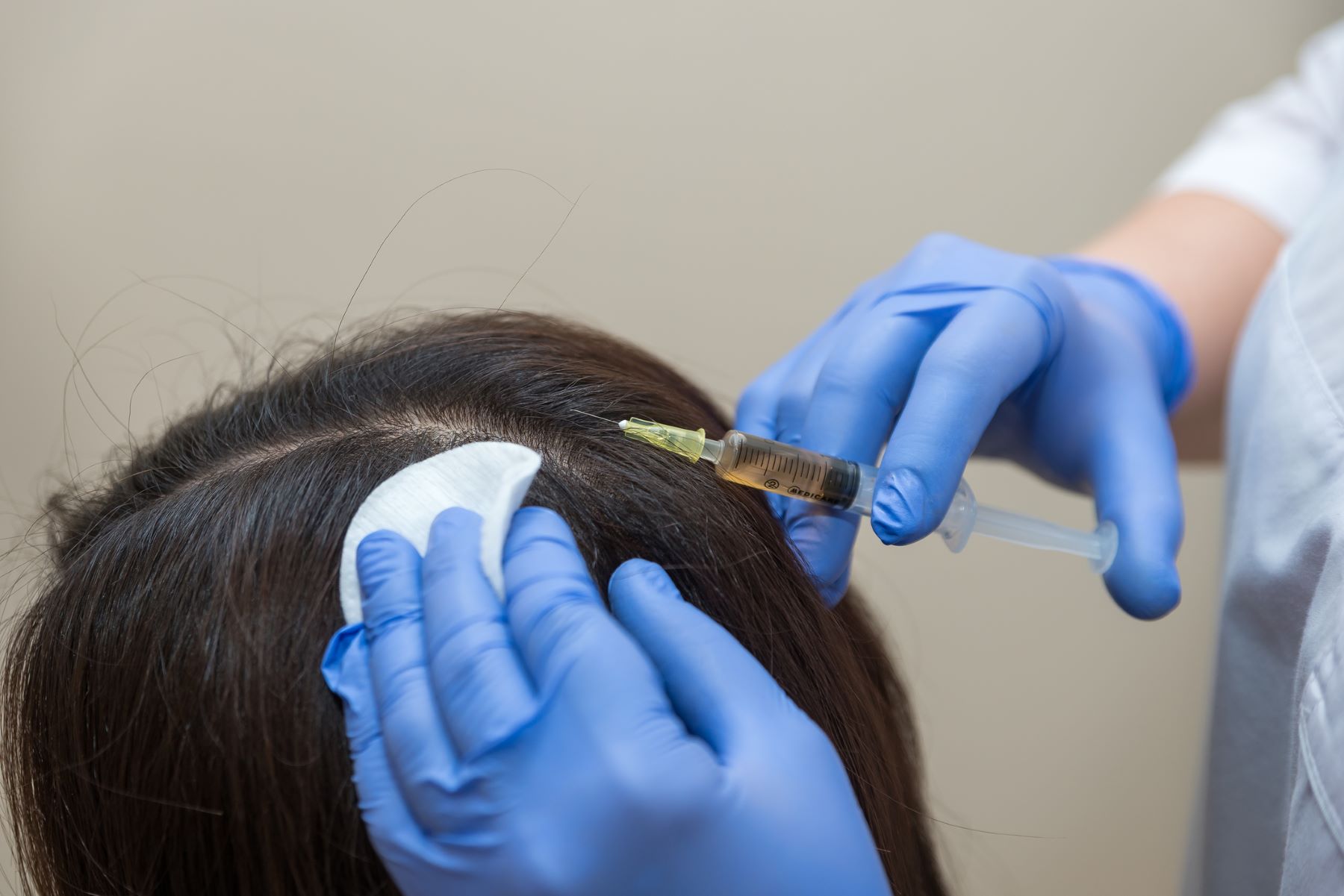 Woman getting PRP hair treatment