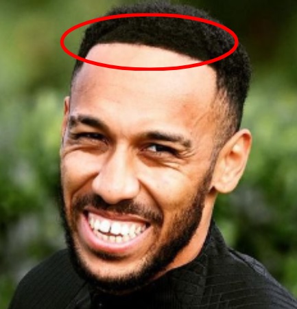 Auba’s new hairline looking suspicious