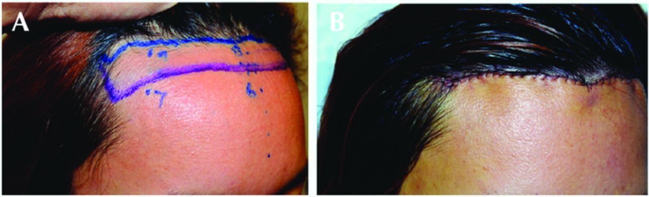 Before and after forehead reduction surgery