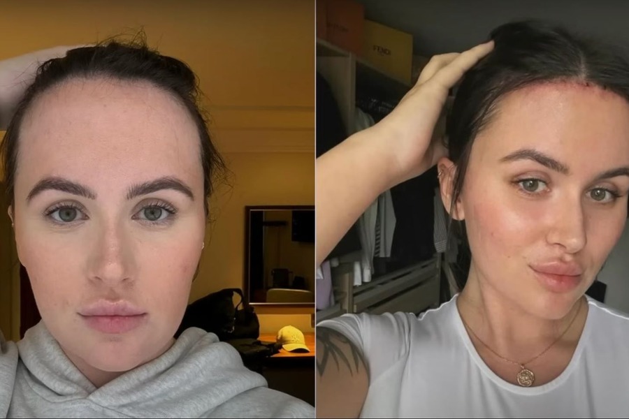 Beth Halsey’s Forehead Reduction: How It Changed Her Life