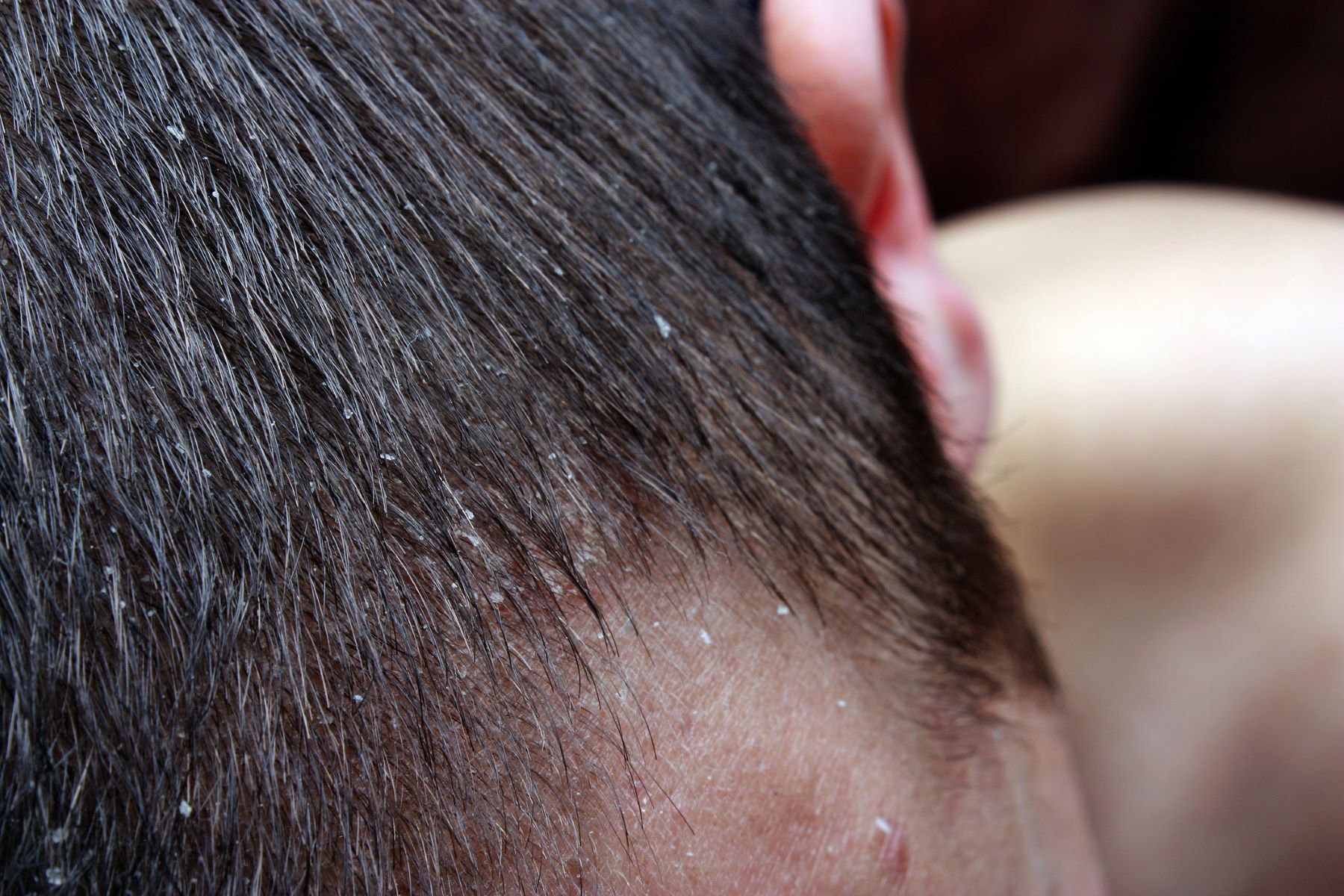 Man with dandruff and hair loss