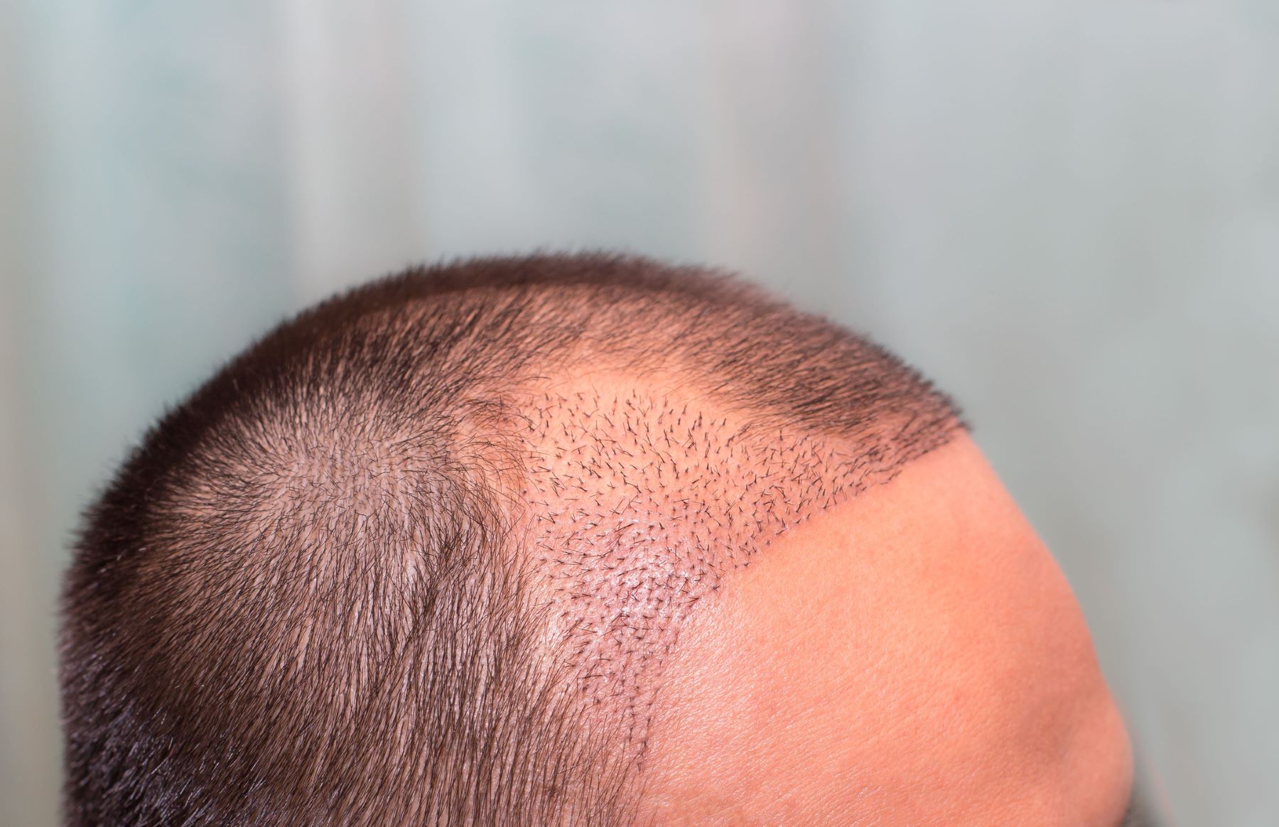 Hairline transplant for a receding hairline