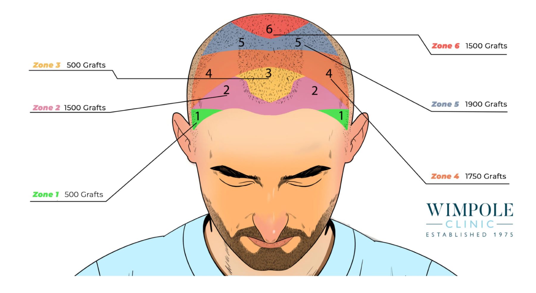 Hair graft calculator