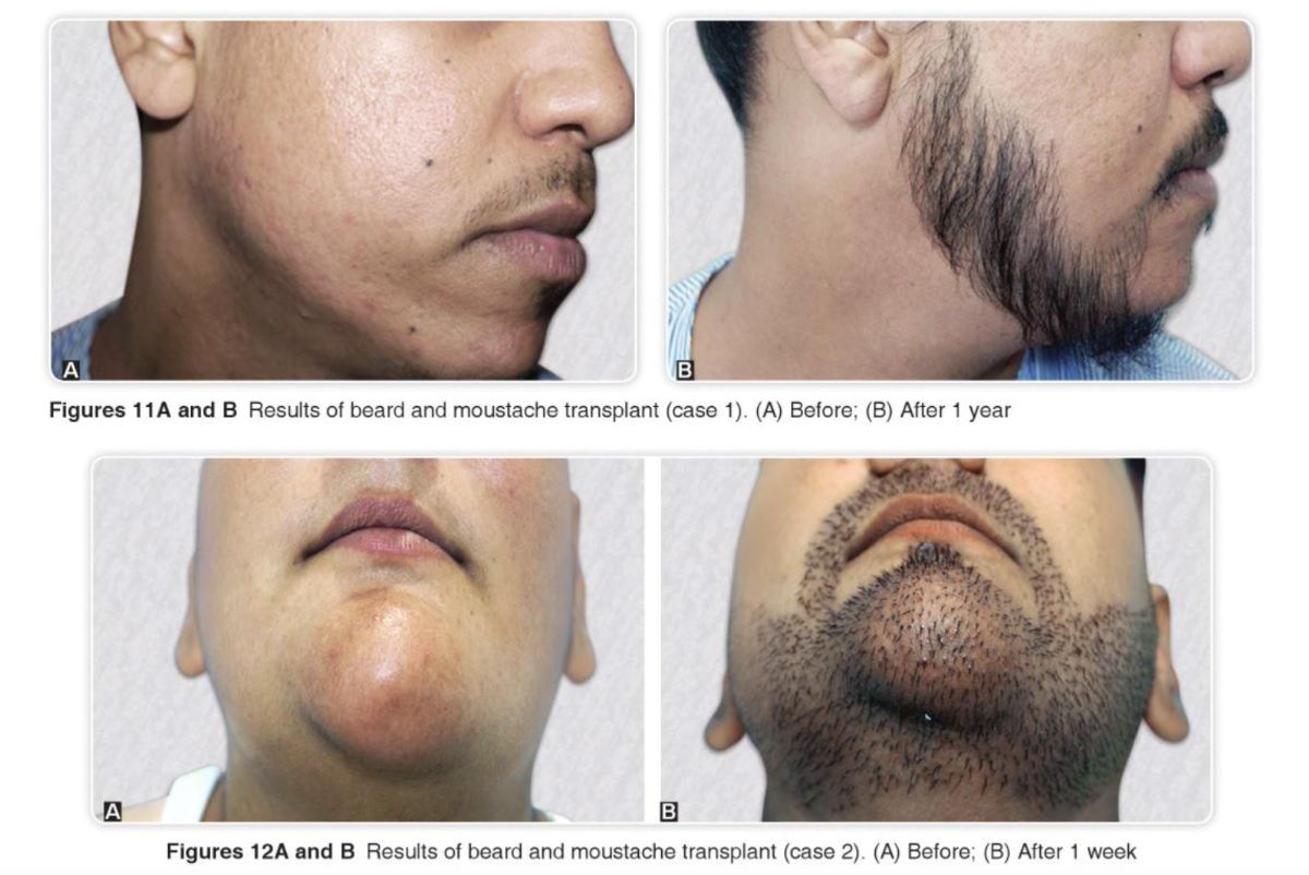 Results of a beard and moustache transplant