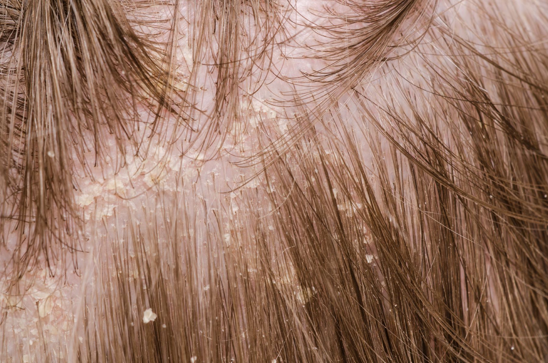 Woman with female pattern baldness and dandruff