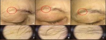 Female patient before and after 10 sessions of LLLT