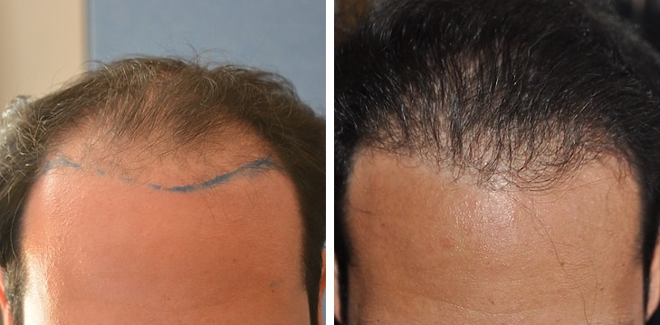 FUT hair transplant after 1 year