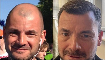 Hair transplant before and after