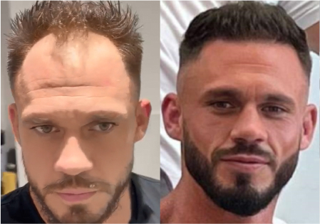 Hair transplant before and after