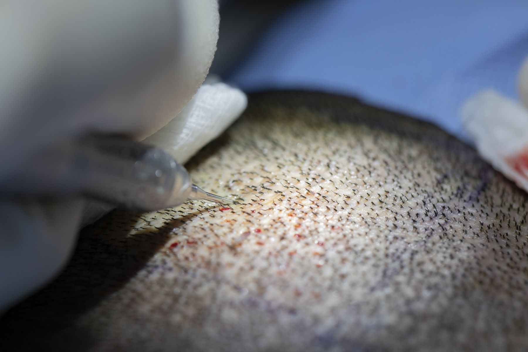 Hair transplant being performed