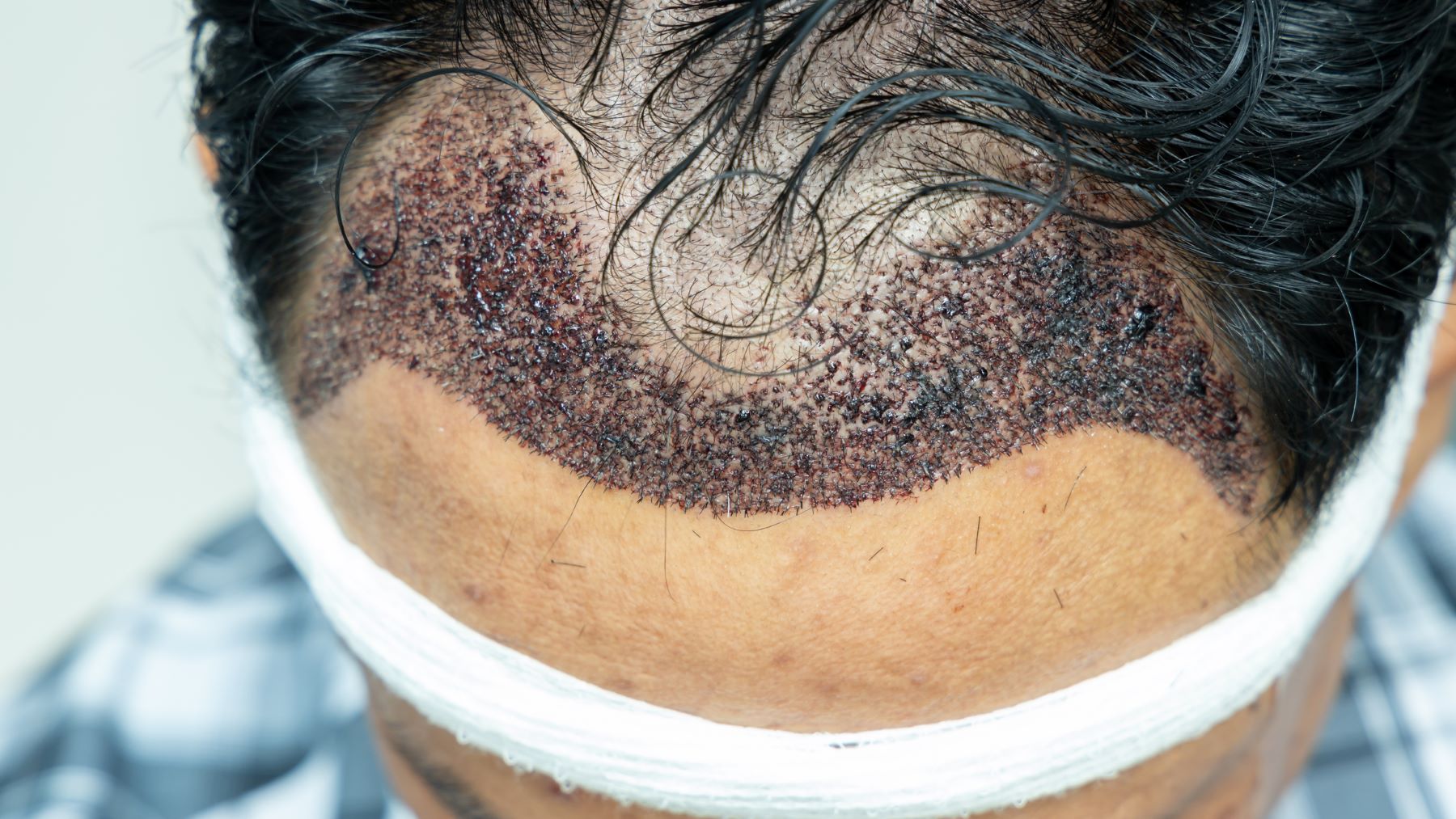 Hair transplant recovery process