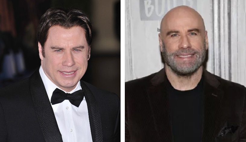 John Travolta’s Hair Transplant: Toupee Or Not Toupee?