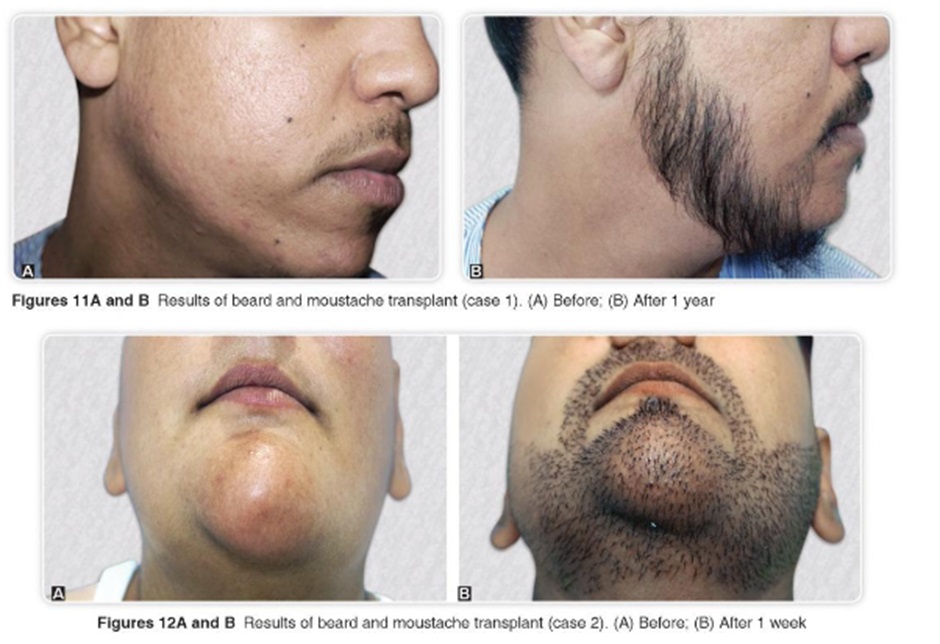 Male patients before and after a moustache transplant