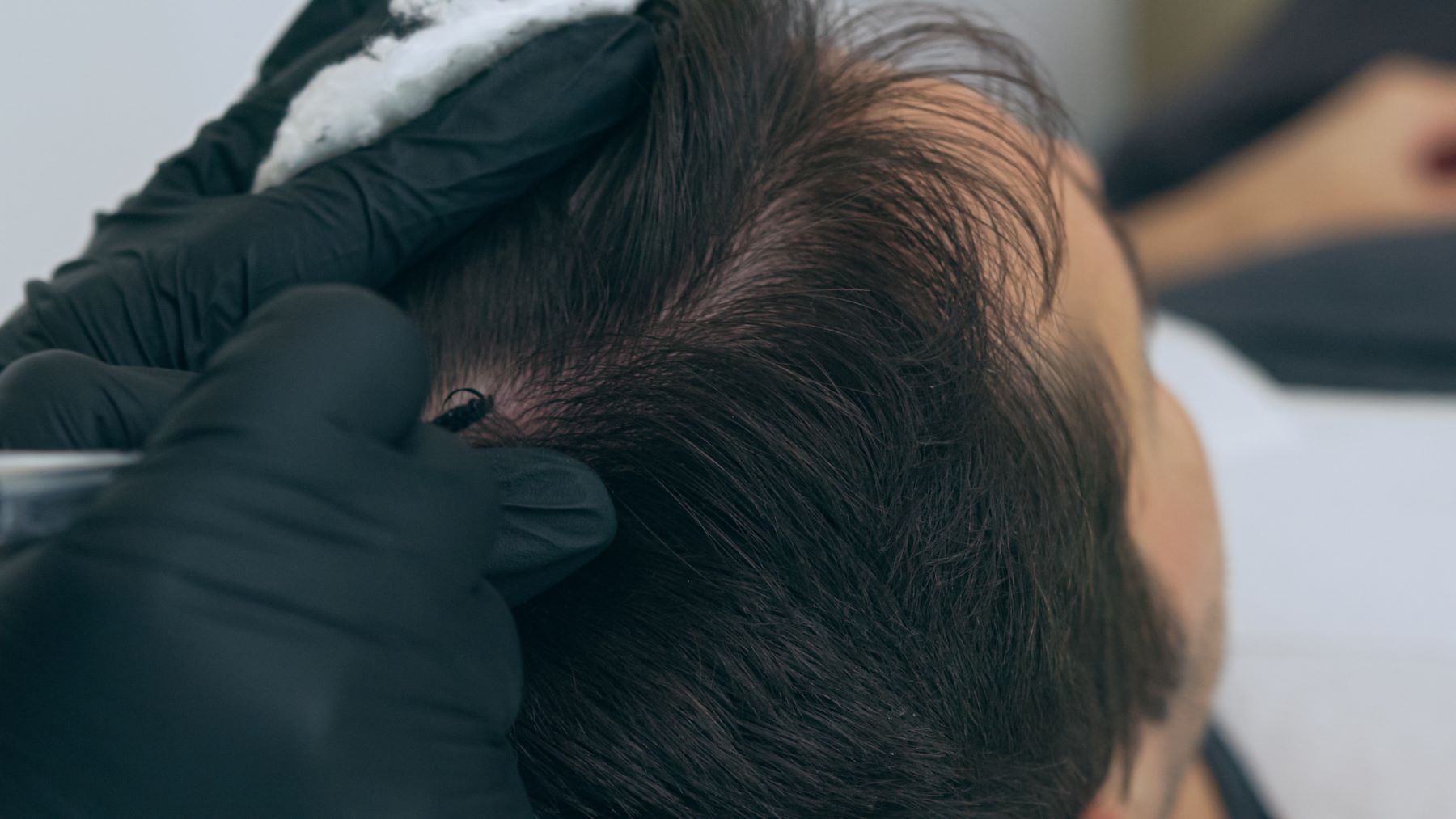 Person undergoing scalp micropigmentation