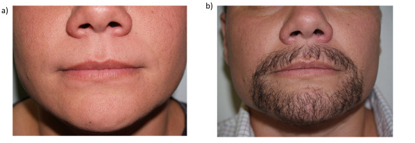 Trans man before and after facial hair transplant