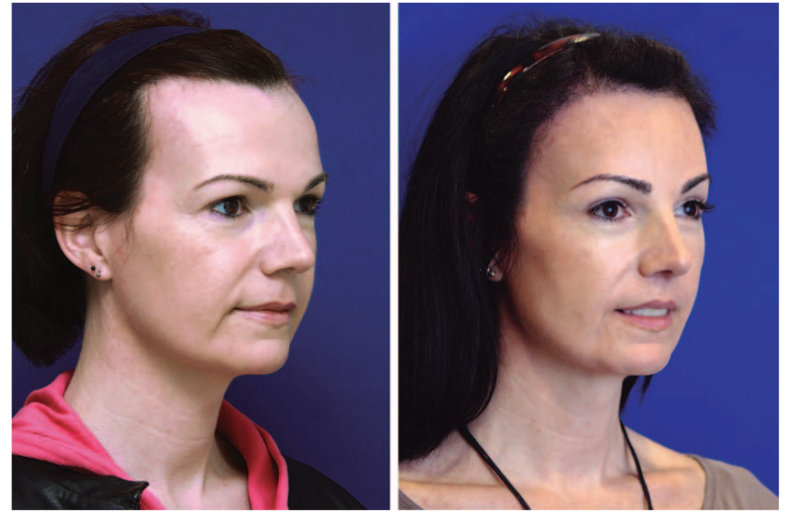 Trans woman before and after FFS and hairline feminisation