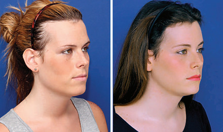 Transgender Hair Transplant: Benefits, Risks And Costs