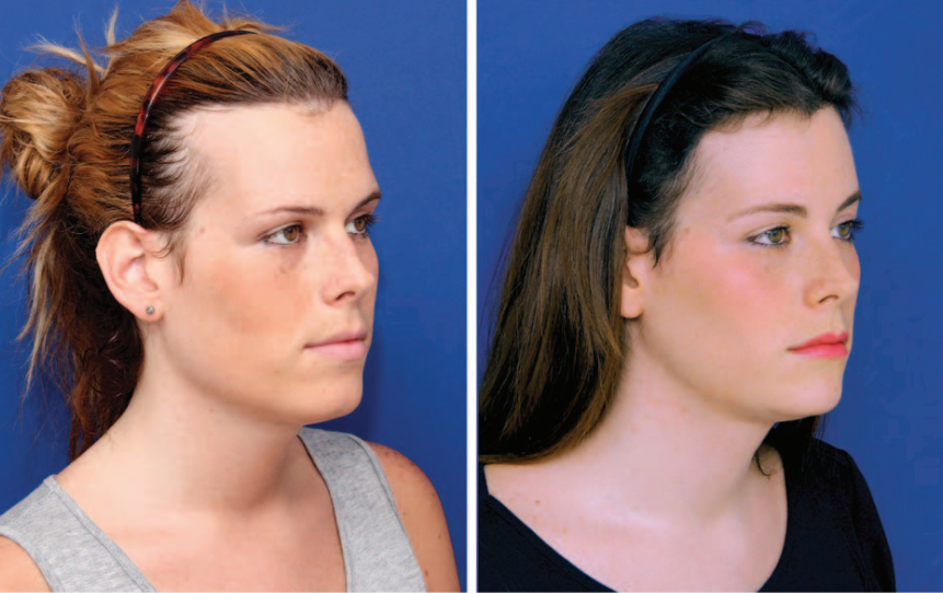 Transgender Hair Transplant: Benefits, Risks And Costs