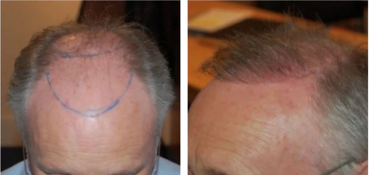 Wimpole Clinic hair transplant after 3 months