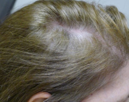 Woman with diffuse hair loss