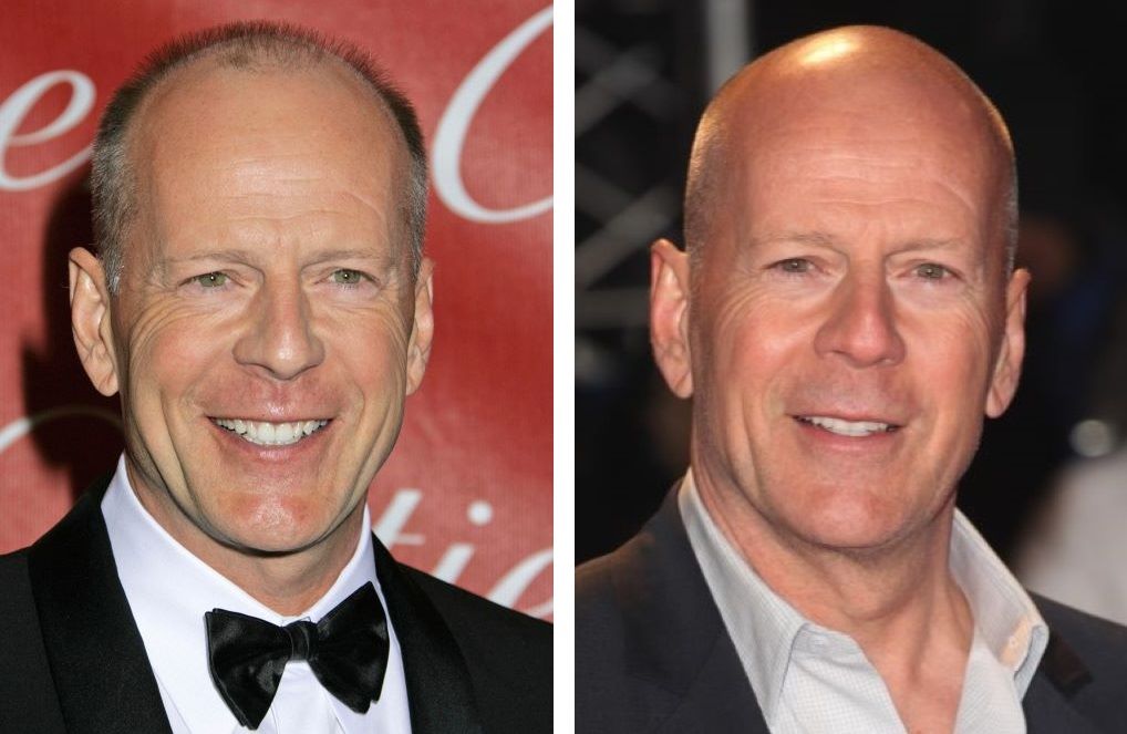 Bruce Willis with some hair (left) and completely bald (right)