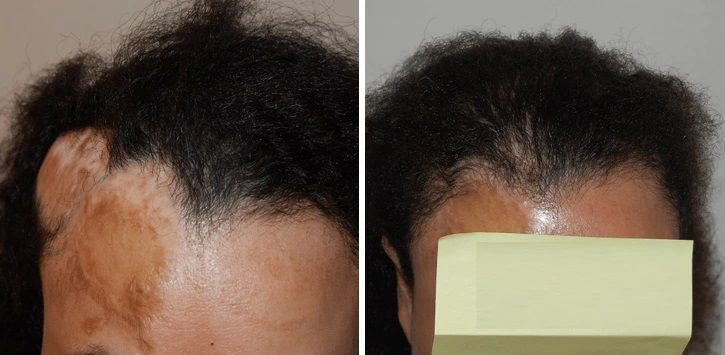 Female hair transplant on scar tissue