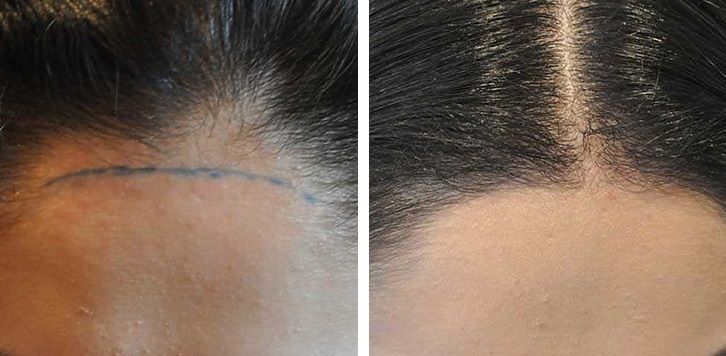 Female hair transplant on the hairline