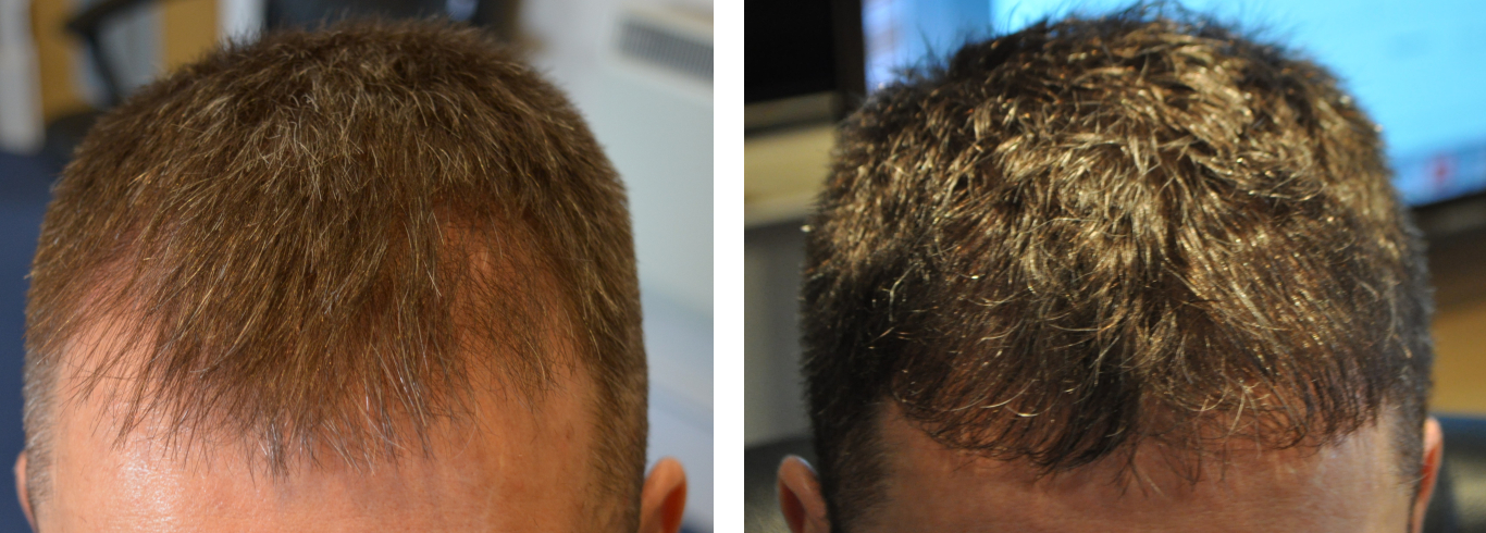 Patient before and after FUE hair transplant